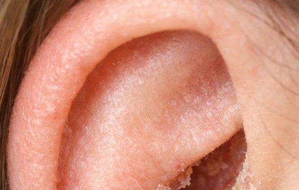 The skin inside my ears keeps drying out and flaking in February. What causes this?
