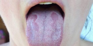 The first sign of vitamin B12 deficiency is…