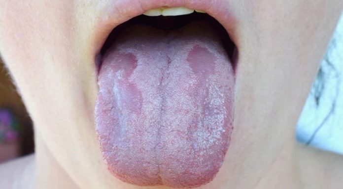 The first sign of vitamin B12 deficiency is…
