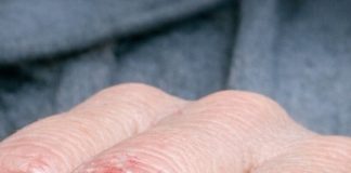 My knuckles keep cracking open and burning in cold weather, and I can’t get medical advice yet. What helps right now?