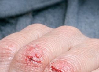 My knuckles keep cracking open and burning in cold weather, and I can’t get medical advice yet. What helps right now?