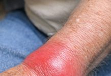 My grandpa’s wrist is suddenly red, hot, and extremely swollen. Why is this happening? He is in severe pain and we need help.