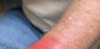 My grandpa’s wrist is suddenly red, hot, and extremely swollen. Why is this happening? He is in severe pain and we need help.
