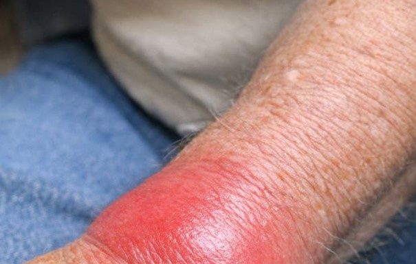 My grandpa’s wrist is suddenly red, hot, and extremely swollen. Why is this happening? He is in severe pain and we need help.
