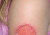 woke up to this red circle on my daughter’s arm. it’s spreading fast and she’s crying from the itch. any advice?