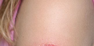 woke up to this red circle on my daughter’s arm. it’s spreading fast and she’s crying from the itch. any advice?