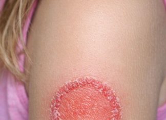 woke up to this red circle on my daughter’s arm. it’s spreading fast and she’s crying from the itch. any advice?