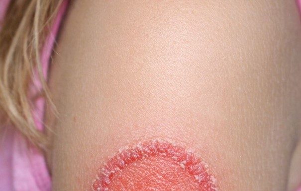 woke up to this red circle on my daughter’s arm. it’s spreading fast and she’s crying from the itch. any advice?