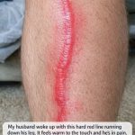 My husband woke up with this hard red line running down his leg. It feels warm to the touch and he’s in pain. ER wait time is 8 hours. Is this serious?