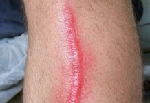 My husband woke up with this hard red line running down his leg. It feels warm to the touch and he’s in pain. ER wait time is 8 hours. Is this serious?