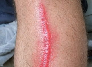 My husband woke up with this hard red line running down his leg. It feels warm to the touch and he’s in pain. ER wait time is 8 hours. Is this serious?