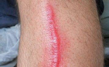 My husband woke up with this hard red line running down his leg. It feels warm to the touch and he’s in pain. ER wait time is 8 hours. Is this serious?
