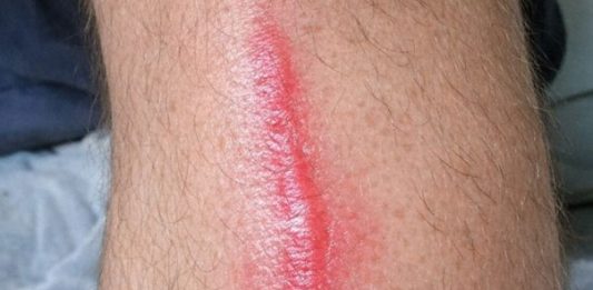 My husband woke up with this hard red line running down his leg. It feels warm to the touch and he’s in pain. ER wait time is 8 hours. Is this serious?