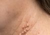 These little skin tags keep popping up around my neck, and I won’t see my doctor for weeks. What can I do right now?