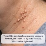 These little skin tags keep popping up around my neck, and I won’t see my doctor for weeks. What can I do right now?