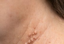 These little skin tags keep popping up around my neck, and I won’t see my doctor for weeks. What can I do right now?