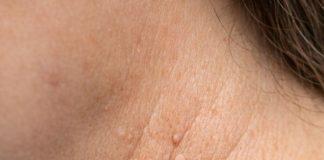 These little skin tags keep popping up around my neck, and I won’t see my doctor for weeks. What can I do right now?
