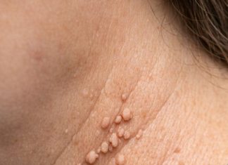 These little skin tags keep popping up around my neck, and I won’t see my doctor for weeks. What can I do right now?