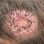 Noticed this red ring on my daughter’s head and the hair is snapping off. It’s spreading fast. Any home remedies before the ER?