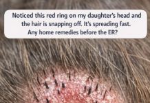 Noticed this red ring on my daughter’s head and the hair is snapping off. It’s spreading fast. Any home remedies before the ER?