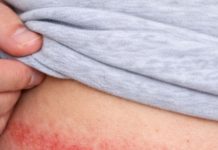 An itchy red rash keeps showing up where my waistband rests, and my doctor visit is weeks away. What can I do right now?