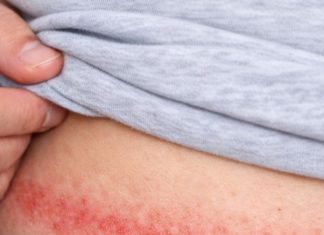 An itchy red rash keeps showing up where my waistband rests, and my doctor visit is weeks away. What can I do right now?