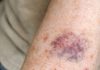 Why Does My Arm Skin Bruise and Tear So Easily? What Changed and What You Can Do
