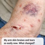 Why Does My Arm Skin Bruise and Tear So Easily? What Changed and What You Can Do