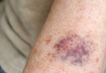 Why Does My Arm Skin Bruise and Tear So Easily? What Changed and What You Can Do