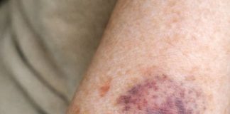 Why Does My Arm Skin Bruise and Tear So Easily? What Changed and What You Can Do