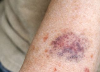 Why Does My Arm Skin Bruise and Tear So Easily? What Changed and What You Can Do