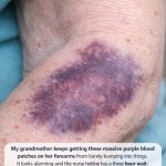 My grandmother keeps getting these massive purple blood patches on her forearms from barely bumping into things. It looks alarming and the nurse hotline has a three hour wait. Is this dangerous?