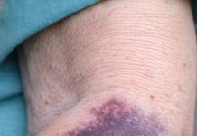 My grandmother keeps getting these massive purple blood patches on her forearms from barely bumping into things. It looks alarming and the nurse hotline has a three hour wait. Is this dangerous?