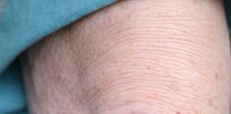 My grandmother keeps getting these massive purple blood patches on her forearms from barely bumping into things. It looks alarming and the nurse hotline has a three hour wait. Is this dangerous?