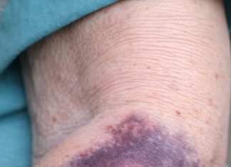 My grandmother keeps getting these massive purple blood patches on her forearms from barely bumping into things. It looks alarming and the nurse hotline has a three hour wait. Is this dangerous?
