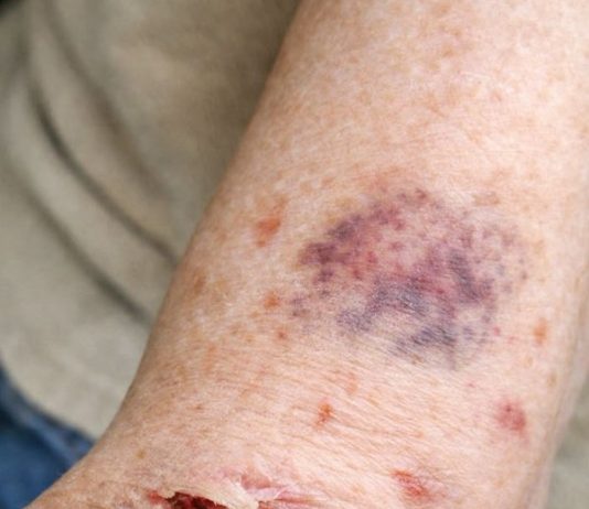Why Does My Arm Skin Bruise and Tear So Easily? What Changed and What You Can Do