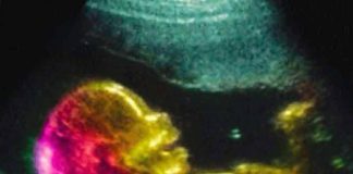 Scientists May Have Actually Found One Of The Causes Of Autism