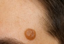 This raised, waxy-looking bump showed up on my temple, and I can’t get checked anytime soon. What is this?