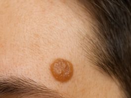 This raised, waxy-looking bump showed up on my temple, and I can’t get checked anytime soon. What is this?