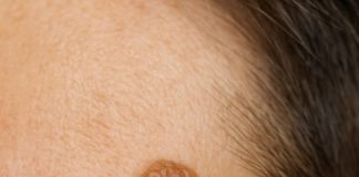 This raised, waxy-looking bump showed up on my temple, and I can’t get checked anytime soon. What is this?