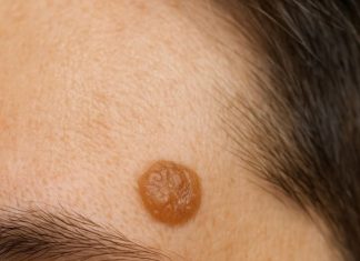 This raised, waxy-looking bump showed up on my temple, and I can’t get checked anytime soon. What is this?