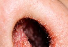 The Inside of My Nose Feels Dry and Irritated Every February — Why Does This Happen?