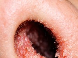 The Inside of My Nose Feels Dry and Irritated Every February — Why Does This Happen?