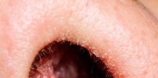 The Inside of My Nose Feels Dry and Irritated Every February — Why Does This Happen?