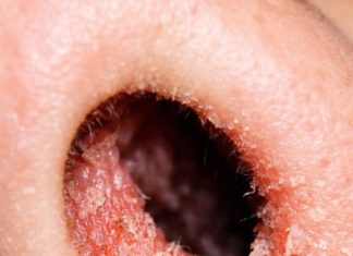 The Inside of My Nose Feels Dry and Irritated Every February — Why Does This Happen?