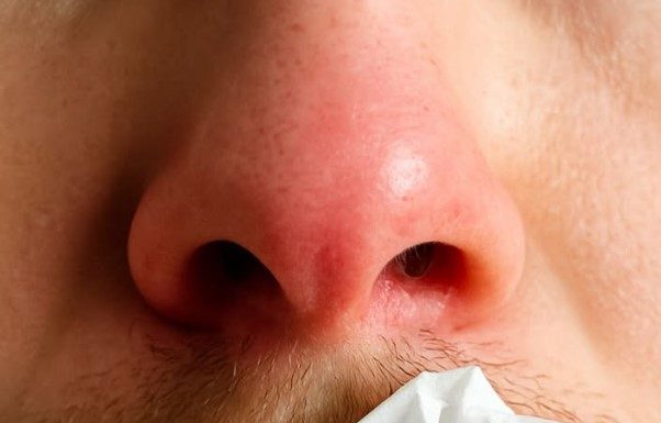 My Nose Keeps Running Indoors During Winter — But I’m Not Sick. What’s Causing It?