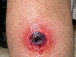 What Could a Painful Sore With a Dark Center on the Calf Be? What to Know When You Can’t Get Urgent Care Right Away