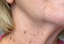 My neighbor Barbara uses this simple three ingredient trick to make stubborn skin tags fall right off