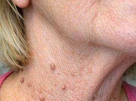 My neighbor Barbara uses this simple three ingredient trick to make stubborn skin tags fall right off