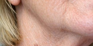 My neighbor Barbara uses this simple three ingredient trick to make stubborn skin tags fall right off